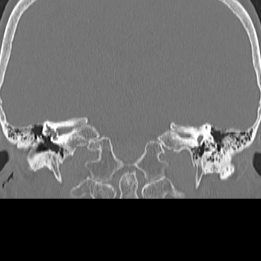 File:Bilateral tympanoplasty (Radiopaedia 16947-16664 Coronal bone window 14).jpg