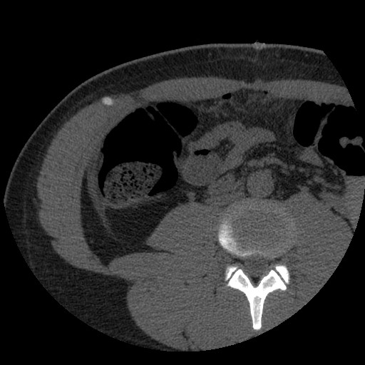 File:Bile leak from liver traumatic laceration (Radiopaedia 63463-72077 Axial Biliscopin 85).jpg