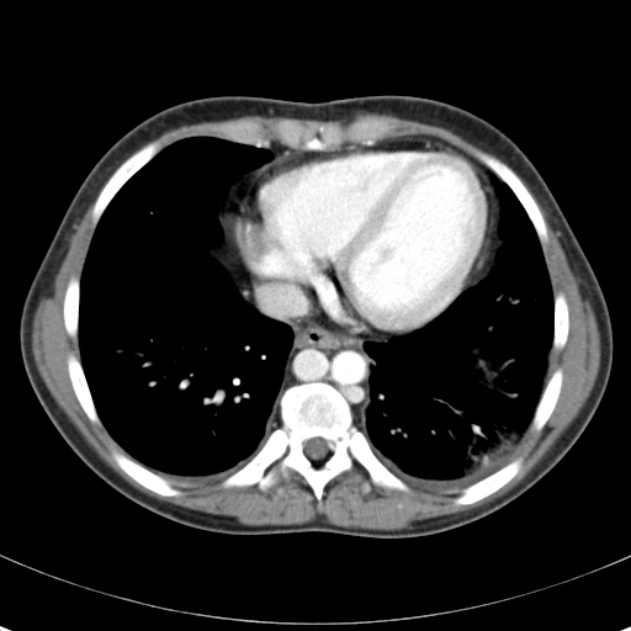 Biliary necrosis - liver transplant (Radiopaedia 21876-21846 B 3).jpg