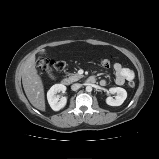 File:Billroth I gastric resection (Radiopaedia 17685-17425 None 16).jpg