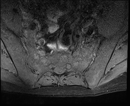 File:Bing-Neel syndrome (Radiopaedia 71453-81799 Axial T1 fat sat 18).jpg