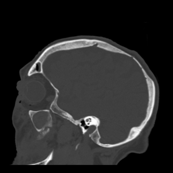 Biparietal osteodystrophy (Radiopaedia 46109-50463 Sagittal bone window 79).jpg