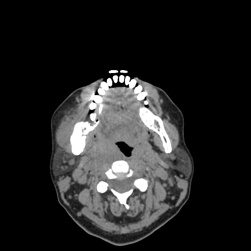 File:Bisphosphonate-related osteonecrosis of the jaw (Radiopaedia 71324-81642 non-contrast 67).jpg