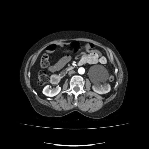 Bladder tumor detected on trauma CT (Radiopaedia 51809-57609 A 111).jpg