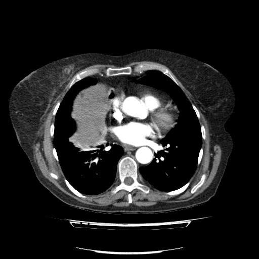 Bladder tumor detected on trauma CT (Radiopaedia 51809-57609 A 56).jpg