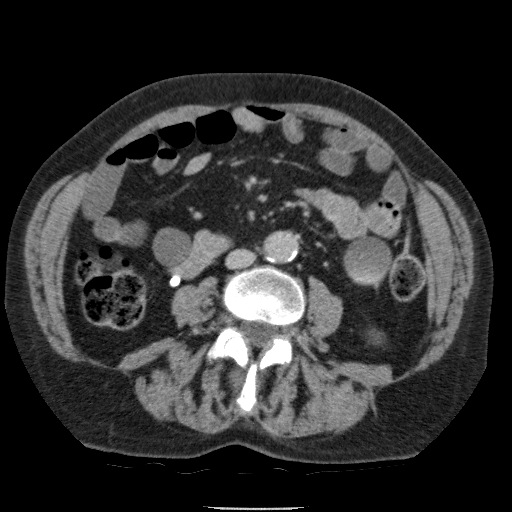 Bladder tumor detected on trauma CT (Radiopaedia 51809-57609 C 74).jpg