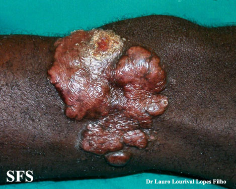 Blastomycosis-Keloidal Blastomycosis (Dermatology Atlas 1).jpg
