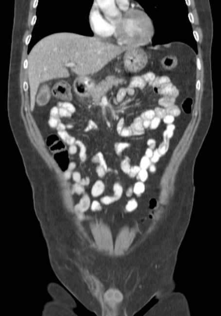 Bleeding duodenal ulcer and adenomyomatosis of gallbladder (Radiopaedia 61834-69861 B 59).jpg