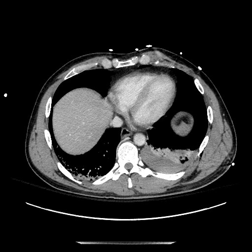 Blunt abdominal trauma with solid organ and musculoskelatal injury with active extravasation (Radiopaedia 68364-77895 A 9).jpg