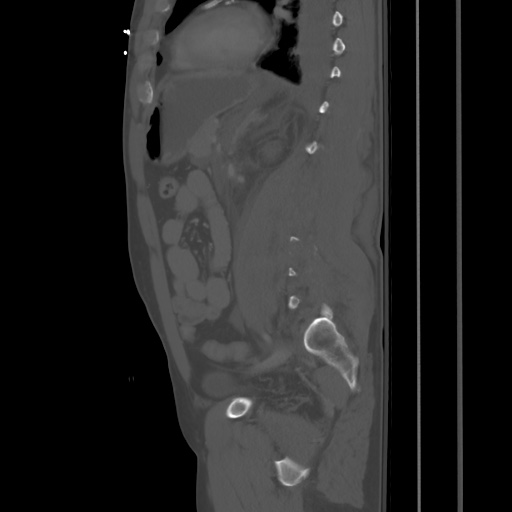 Blunt abdominal trauma with solid organ and musculoskelatal injury with active extravasation (Radiopaedia 68364-77895 Sagittal bone window 66).jpg