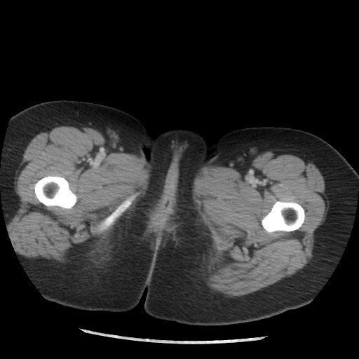File:Borderline mucinous tumor (ovary) (Radiopaedia 78228-90808 A 147).jpg