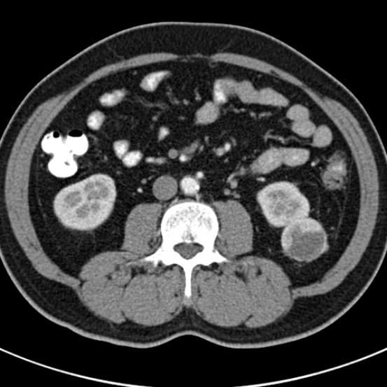 File:Bosniak cyst - type IV (Radiopaedia 23525-23627 renal cortical phase 39).jpg