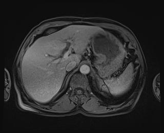 Bouveret syndrome (Radiopaedia 61017-68856 Axial T1 C+ fat sat 21).jpg