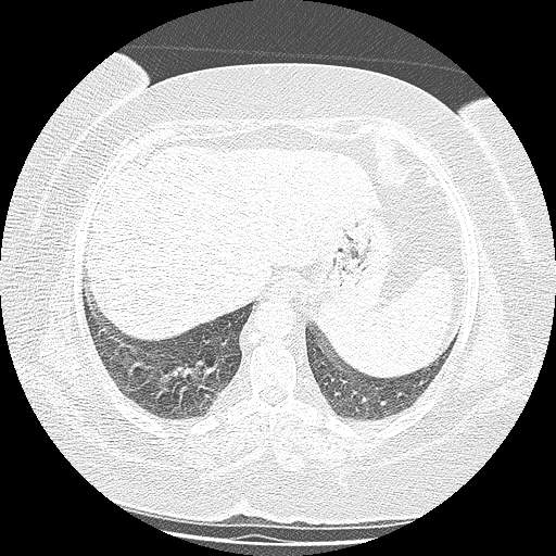 Bovine aortic arch - right internal mammary vein drains into the superior vena cava (Radiopaedia 63296-71875 Axial lung window 140).jpg