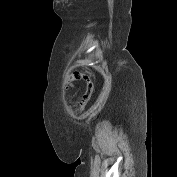 Bowel and splenic infarcts in acute lymphocytic leukemia (Radiopaedia 61055-68915 C 11).jpg