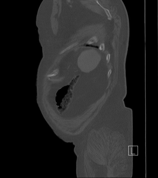 Bowel ischemia secondary to SMA occlusion with extensive portomesenteric venous gas (Radiopaedia 54656-60871 Sagittal bone window 9).jpg