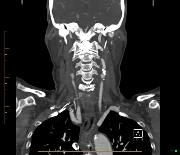 Brachiocephalic trunk stenosis (Radiopaedia 87242-103519 B 41).jpg