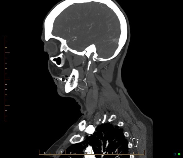 Brachiocephalic trunk stenosis (Radiopaedia 87242-103519 C 50).jpg