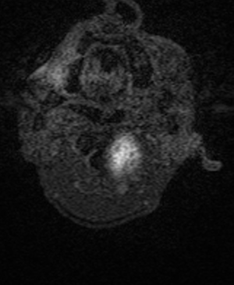 Brain abscess with dual rim sign (Radiopaedia 87566-103938 Axial T1 C+ 1).jpg