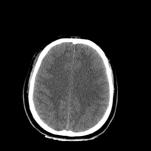 File:Brain contusions, internal carotid artery dissection and base of skull fracture (Radiopaedia 34089-35339 Axial non-contrast 35).png