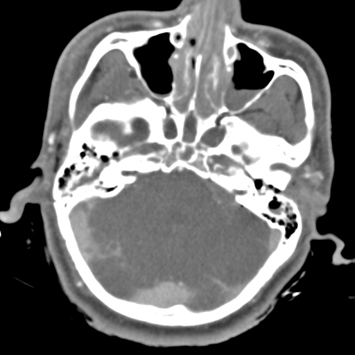 Brain contusions, internal carotid artery dissection and base of skull fracture (Radiopaedia 34089-35339 D 41).png