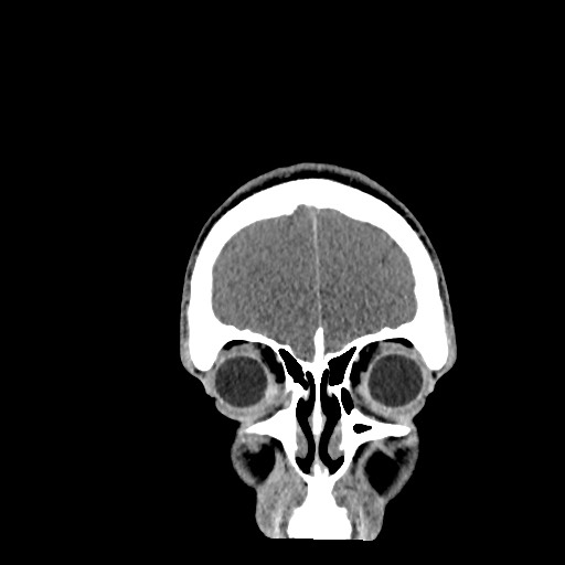 Brain death (Radiopaedia 78597-91360 Coronal non-contrast 12).jpg