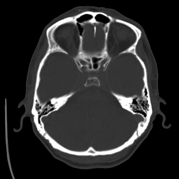Brain metastases from lung cancer (Radiopaedia 24480-24781 Axial bone window 12).jpg
