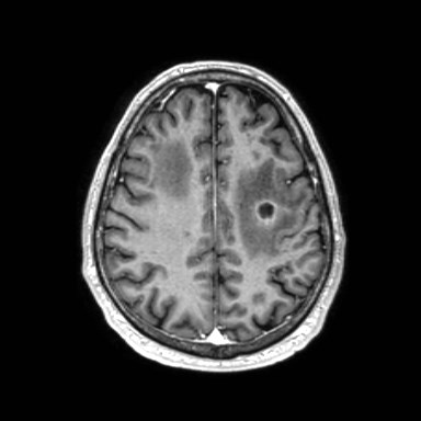 File:Brain metastases from lung cancer (Radiopaedia 83839-99028 Axial T1 C+ 48).jpg