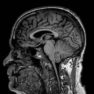 Brain metastases from lung cancer (Radiopaedia 83839-99028 Sagittal T1 68).jpg