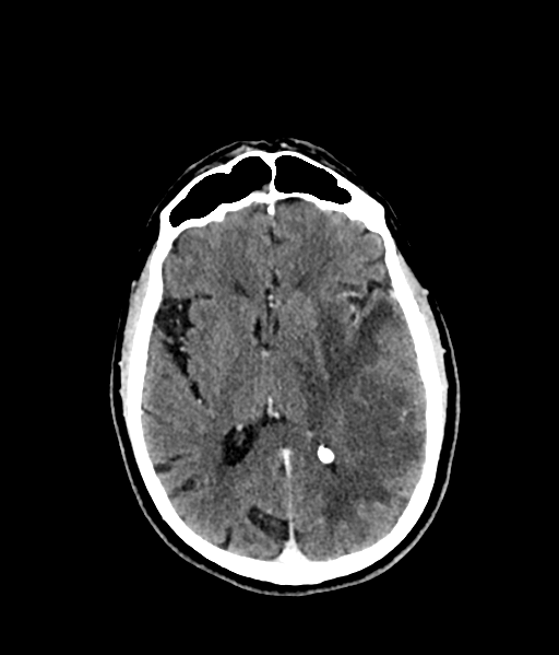 Brain metastasis (large cystic mass) (Radiopaedia 47497-52106 Axial C+ 34).png