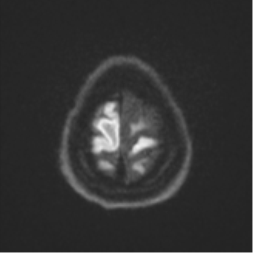Brain metastasis (sarcoma) (Radiopaedia 47576-52209 Axial DWI 53).png