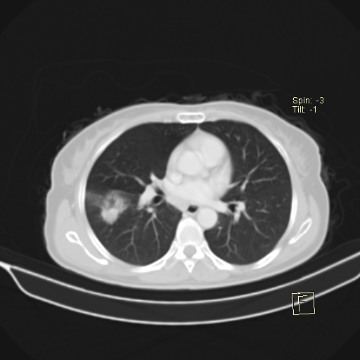 Brain metastasis as initial presentation of non-small cell lung cancer (Radiopaedia 65122-74127 Axial lung window 25).jpg