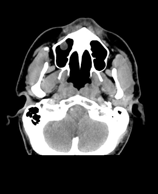 Branchial cleft cyst (Radiopaedia 31167-31875 Axial C+ delayed 6).jpg