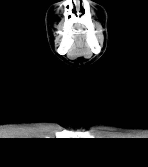 Branchial cleft cyst (Radiopaedia 31167-31875 Coronal C+ delayed 14).jpg
