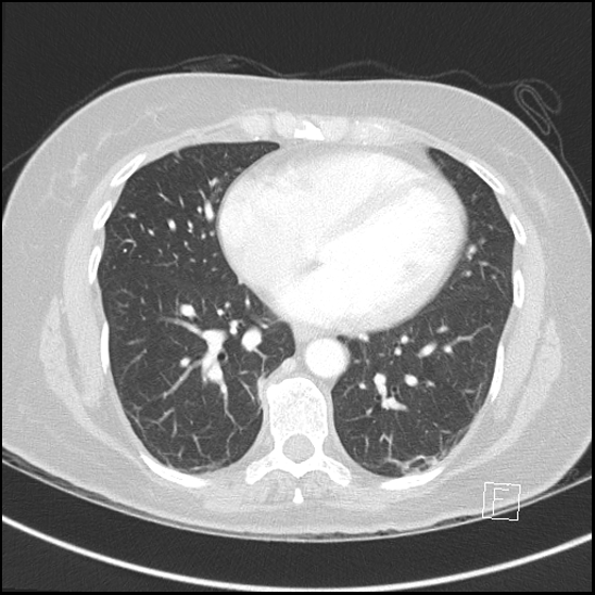 Breast metastases from renal cell cancer (Radiopaedia 79220-92225 Axial lung window 55).jpg