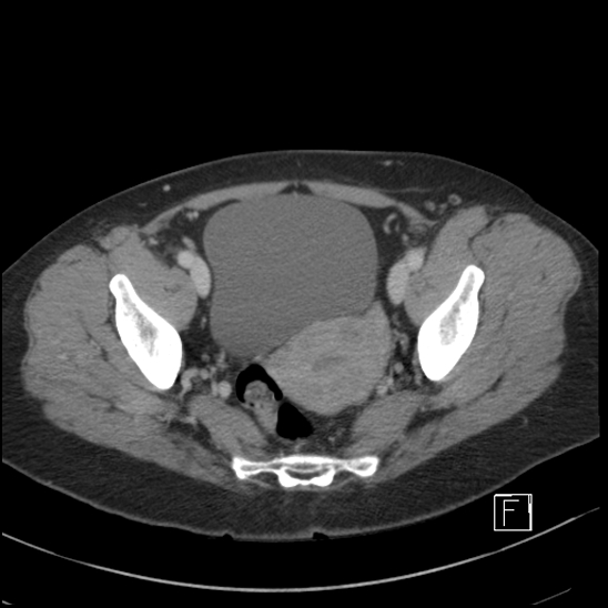 File:Breast metastases from renal cell cancer (Radiopaedia 79220-92225 C 101).jpg