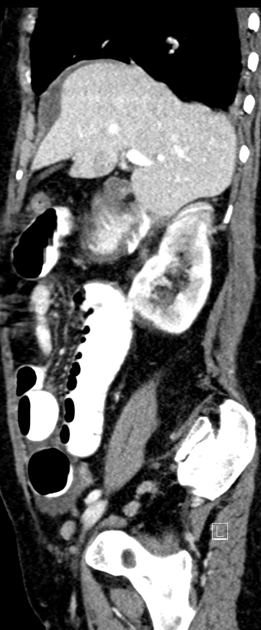 Broad ligament hernia (Radiopaedia 84802-100276 C 57).jpg