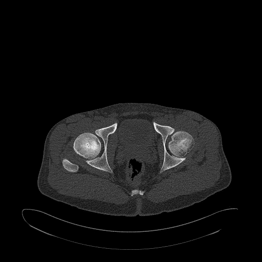 Brodie abscess- femoral neck (Radiopaedia 53862-59966 Axial bone window 151).jpg
