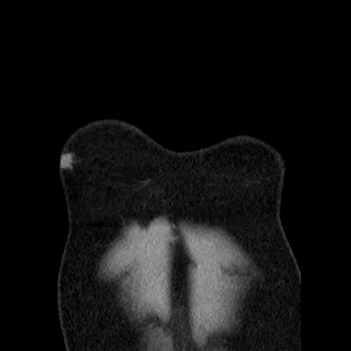 Bronchial carcinoid tumor (Radiopaedia 67377-76764 C 12).jpg
