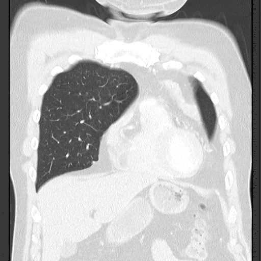 Bronchial carcinoid tumor (Radiopaedia 67377-76764 Coronal lung window 24).jpg