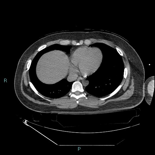 Bronchial carcinoid tumor (Radiopaedia 78272-90870 Axial non-contrast 76).jpg