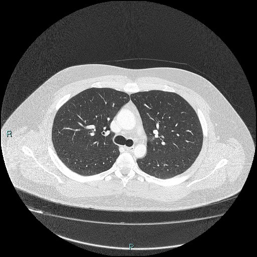 Bronchial carcinoid tumor (Radiopaedia 78272-90875 Axial lung window 17).jpg