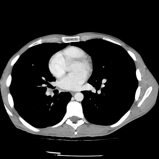 Bronchial carcinoid tumor causing right lower lobe collapse (Radiopaedia 83495-98594 A 29).jpg