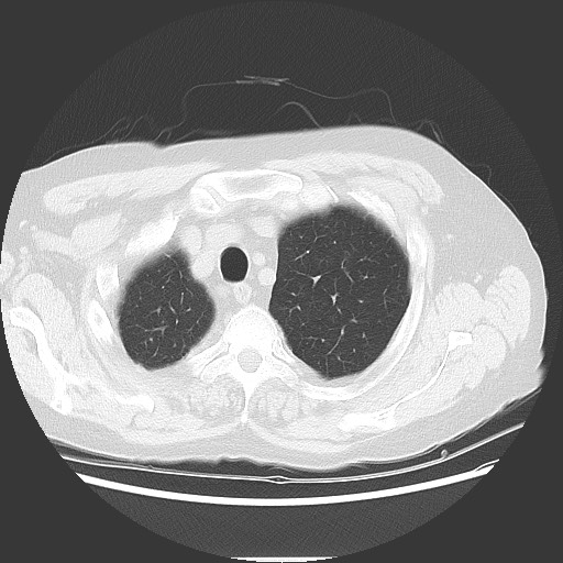Bronchial stenosis - lung transplant (Radiopaedia 73133-83848 Axial lung window 12).jpg