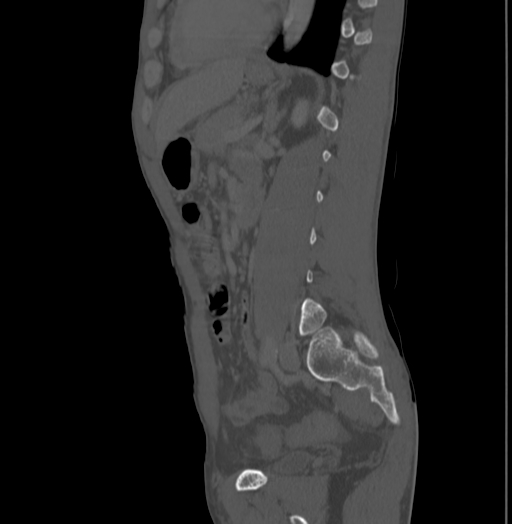 Bronchiectasis in Crohn disease (Radiopaedia 60311-67977 Sagittal bone window 161).jpg