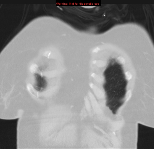 Bronchoalveolar carcinoma (BAC) (Radiopaedia 13436-13392 Coronal lung window 6).jpg