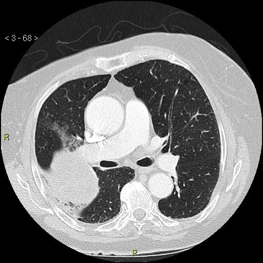 Bronchogenic carcinoma as an incidental finding (Radiopaedia 16453-16130 Axial lung window 68).jpg
