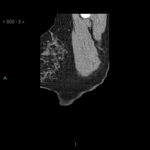 Bronchogenic cyst - posterior mediastinal (Radiopaedia 43885-47364 B 2).jpg