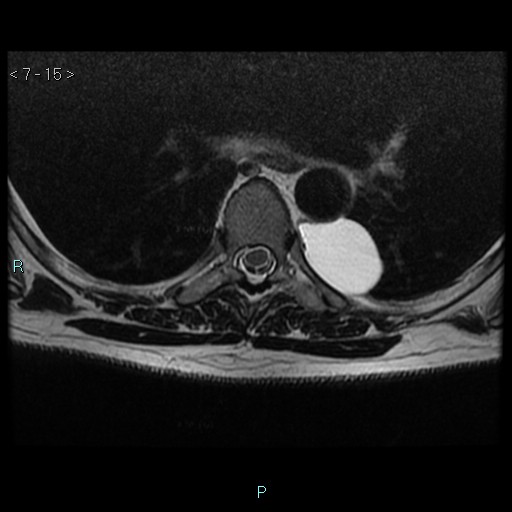 File:Bronchogenic cyst - posterior mediastinal (Radiopaedia 43885-47365 Axial T2 15).jpg