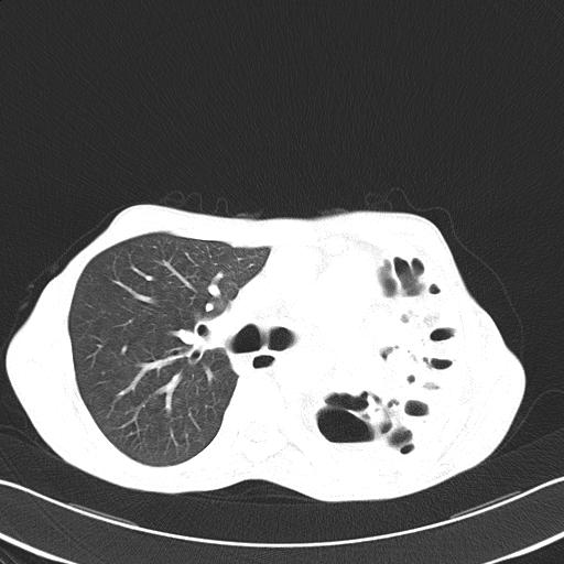 File:Bronchopleural fistula secondary to tuberculosis (Radiopaedia 20415-20322 Axial lung window 24).jpg